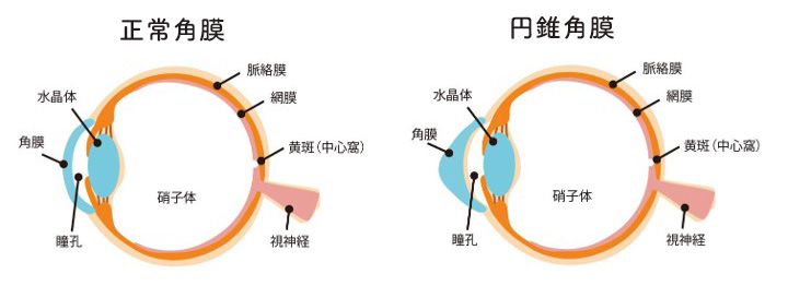 円錐角膜